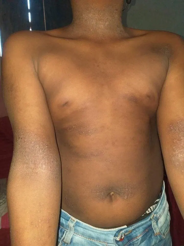 Long-Term Complications and Prognosis